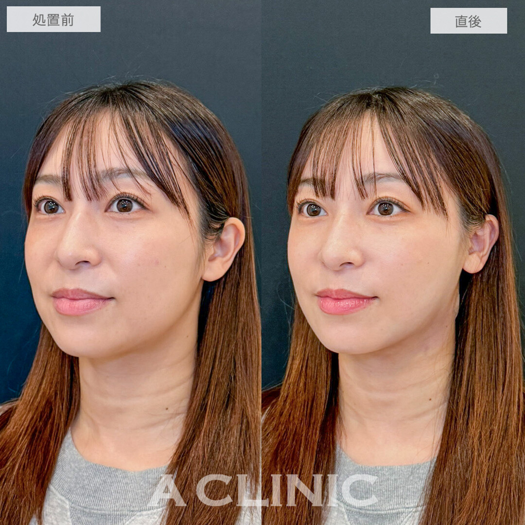 1day小顔脂肪吸引で直後からほうれい線もなくなり若々しい印象に！処置前と直後の症例です(30代女性)