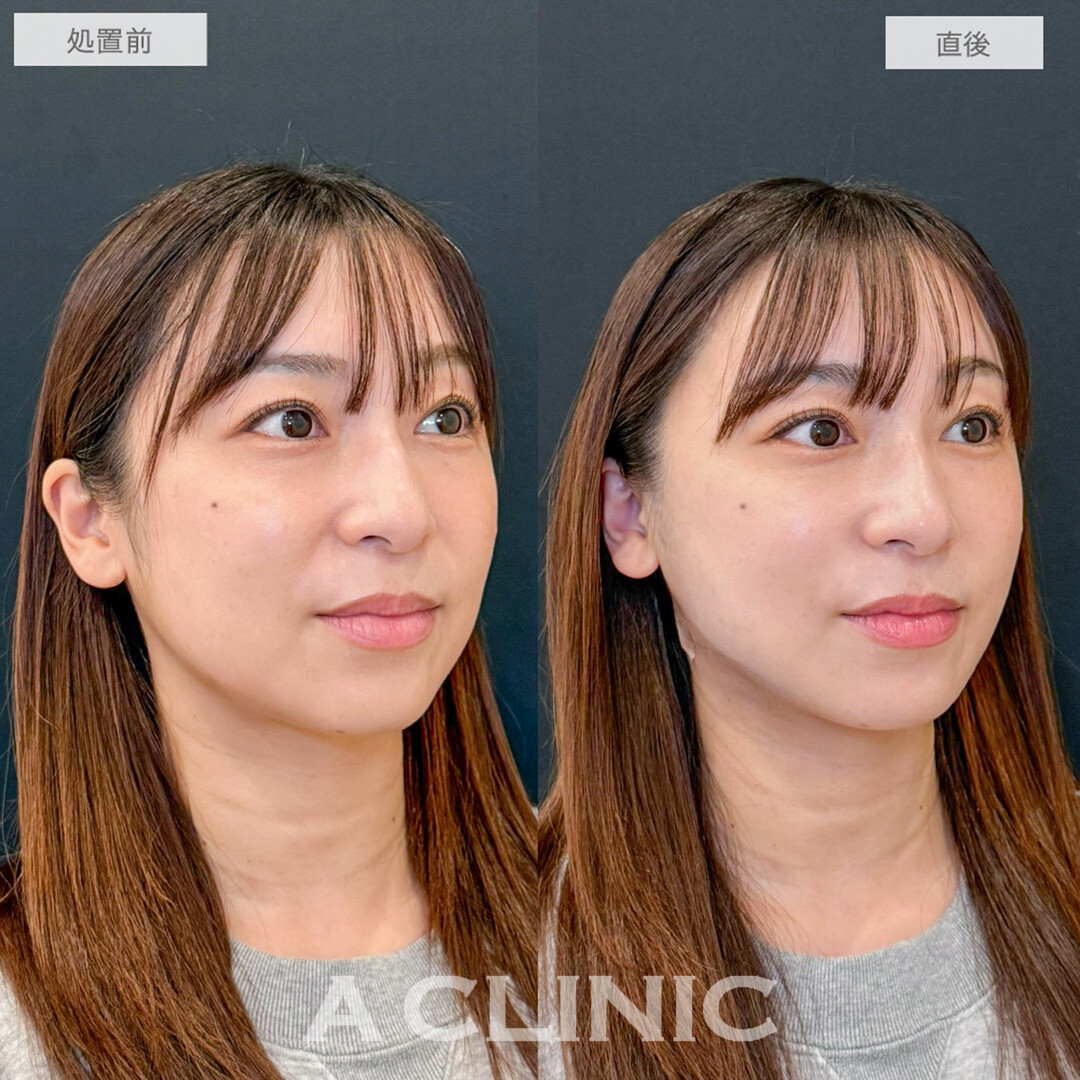 1day小顔脂肪吸引で直後からほうれい線もなくなり若々しい印象に！処置前と直後の症例です(30代女性)