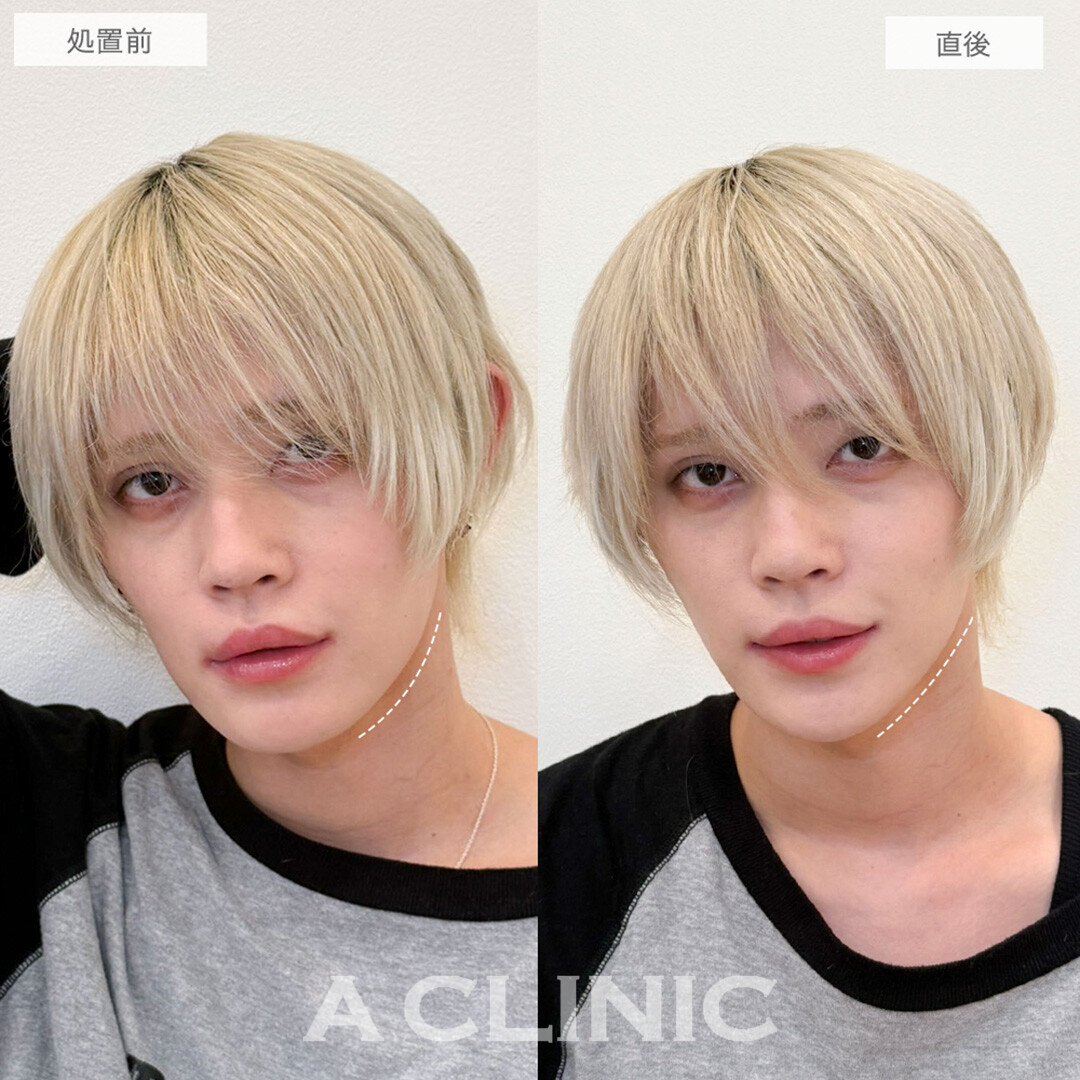 Aスレッドでもたつきが解消されさらにイケメンにパワーアップ！処置前と直後の症例です(20代男性)