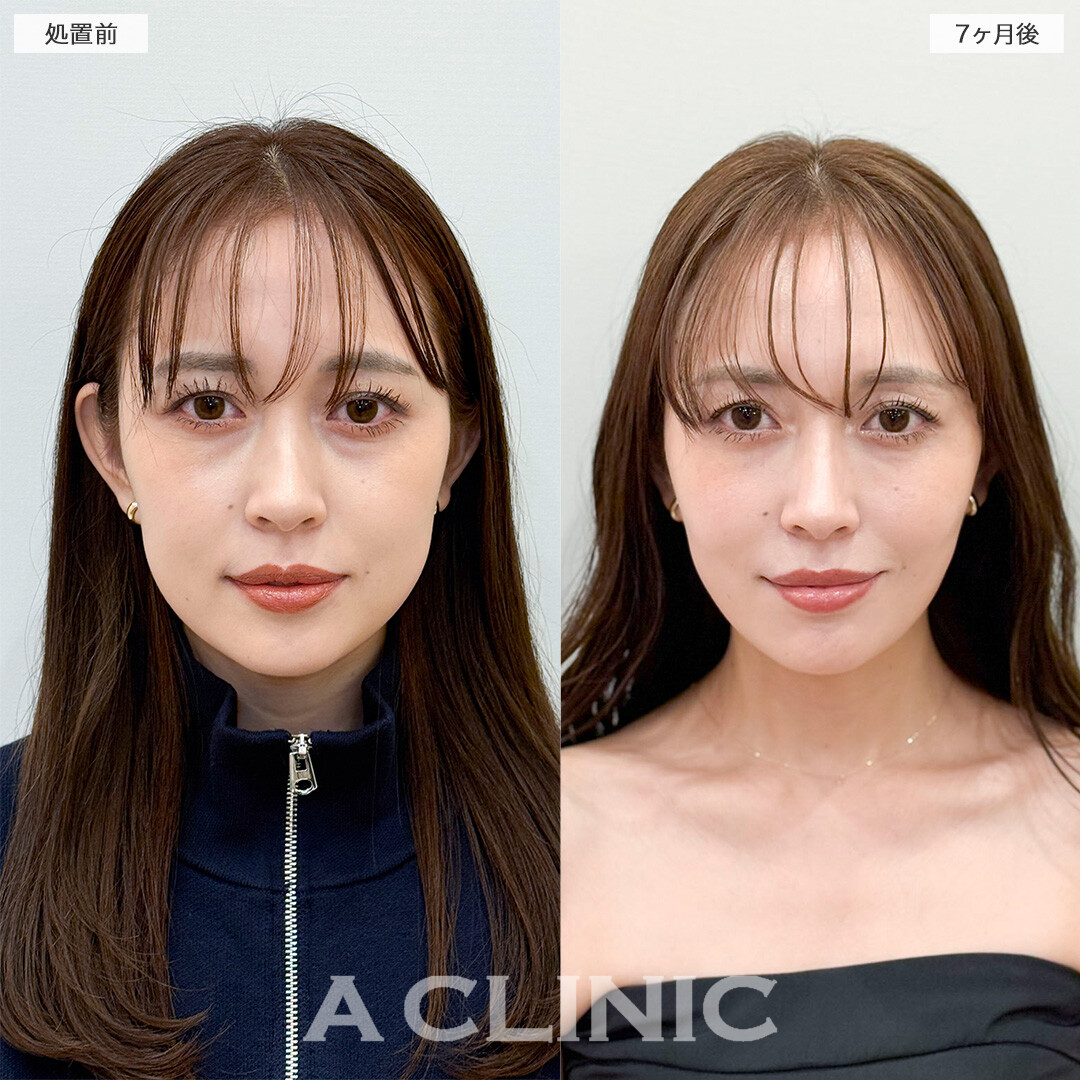 1day小顔脂肪吸引とバッカルファット除去術で半年経っても綺麗な輪郭！処置前と7ヶ月後の症例です(30代女性)