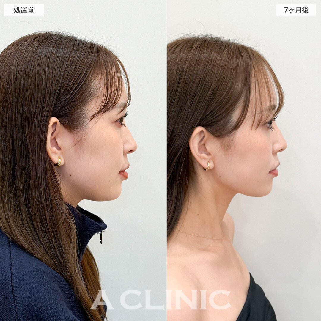 1day小顔脂肪吸引とバッカルファット除去術で半年経っても綺麗な輪郭！処置前と7ヶ月後の症例です(30代女性)