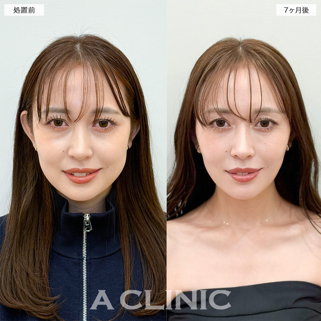 1day小顔脂肪吸引とバッカルファット除去術で半年経っても綺麗な輪郭！処置前と7ヶ月後の症例です(30代女性)