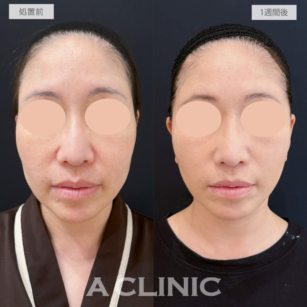 A式たるみ切開でたるみで歪んだ輪郭を若々しい卵型フェイスに戻せました！処置前と1週間後の症例です(50代女性)