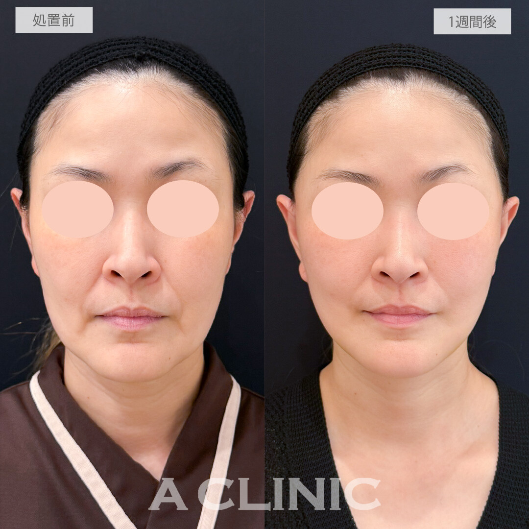A式たるみ切開と1day小顔脂肪吸引で1週間でも変化を実感しここからさらに変化していく経過も楽しめます！処置前と1週間後の症例です(40代女性)