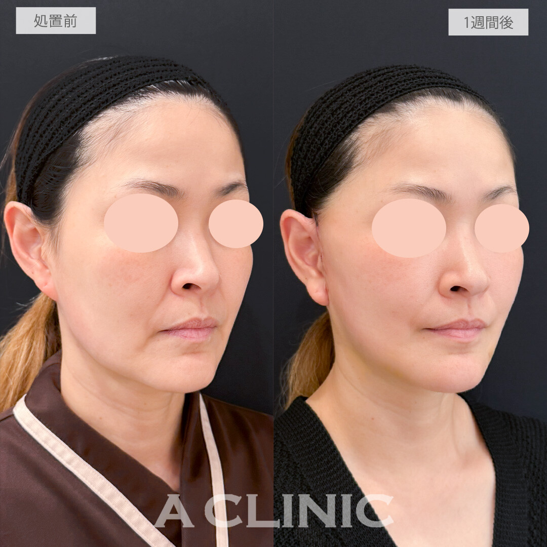 A式たるみ切開と1day小顔脂肪吸引で1週間でも変化を実感しここからさらに変化していく経過も楽しめます！処置前と1週間後の症例です(40代女性)