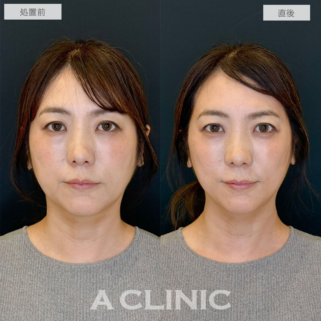 Aスレッドで口元のもたつき改善し若見え成功しました！こちら処置前と直後の症例です(40代女性)