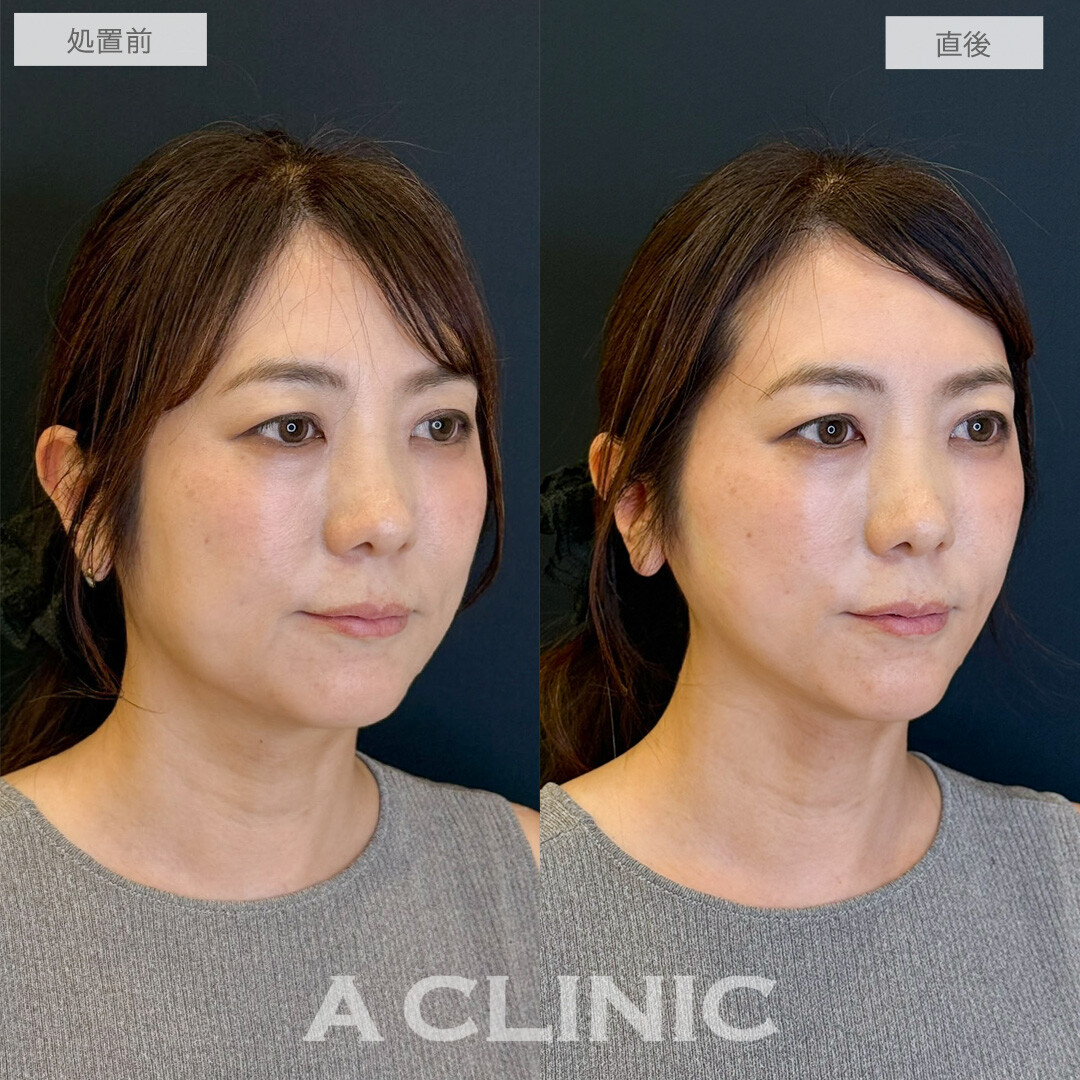 Aスレッドで口元のもたつき改善し若見え成功しました！こちら処置前と直後の症例です(40代女性)