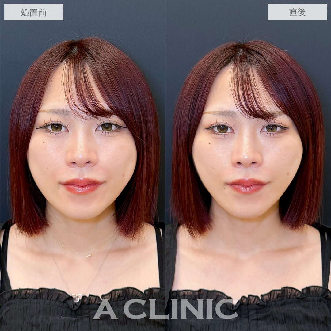 Aスレッドでキュッと引き締まったVフェイスに！処置前と直後の症例です(30代女性)