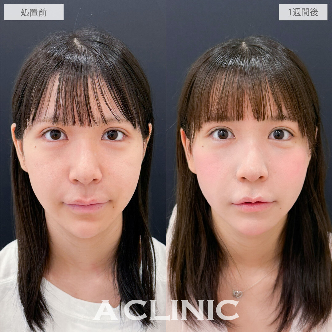 A式コンシーラー注射でふっくらハリ感を出して明るい印象の瞳に！こちら処置前と1週間後の症例です(20代女性)
