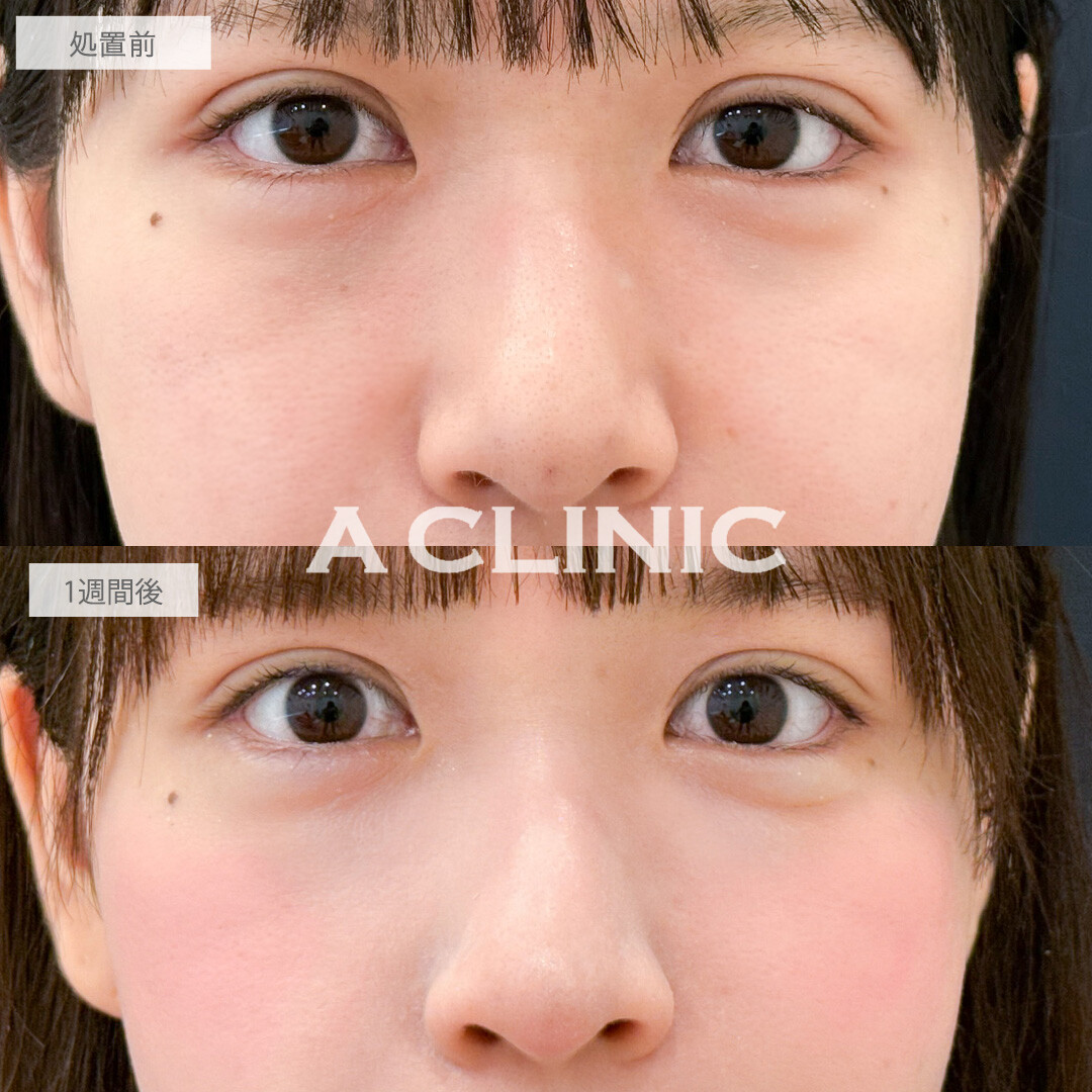 A式コンシーラー注射でふっくらハリ感を出して明るい印象の瞳に！こちら処置前と1週間後の症例です(20代女性)
