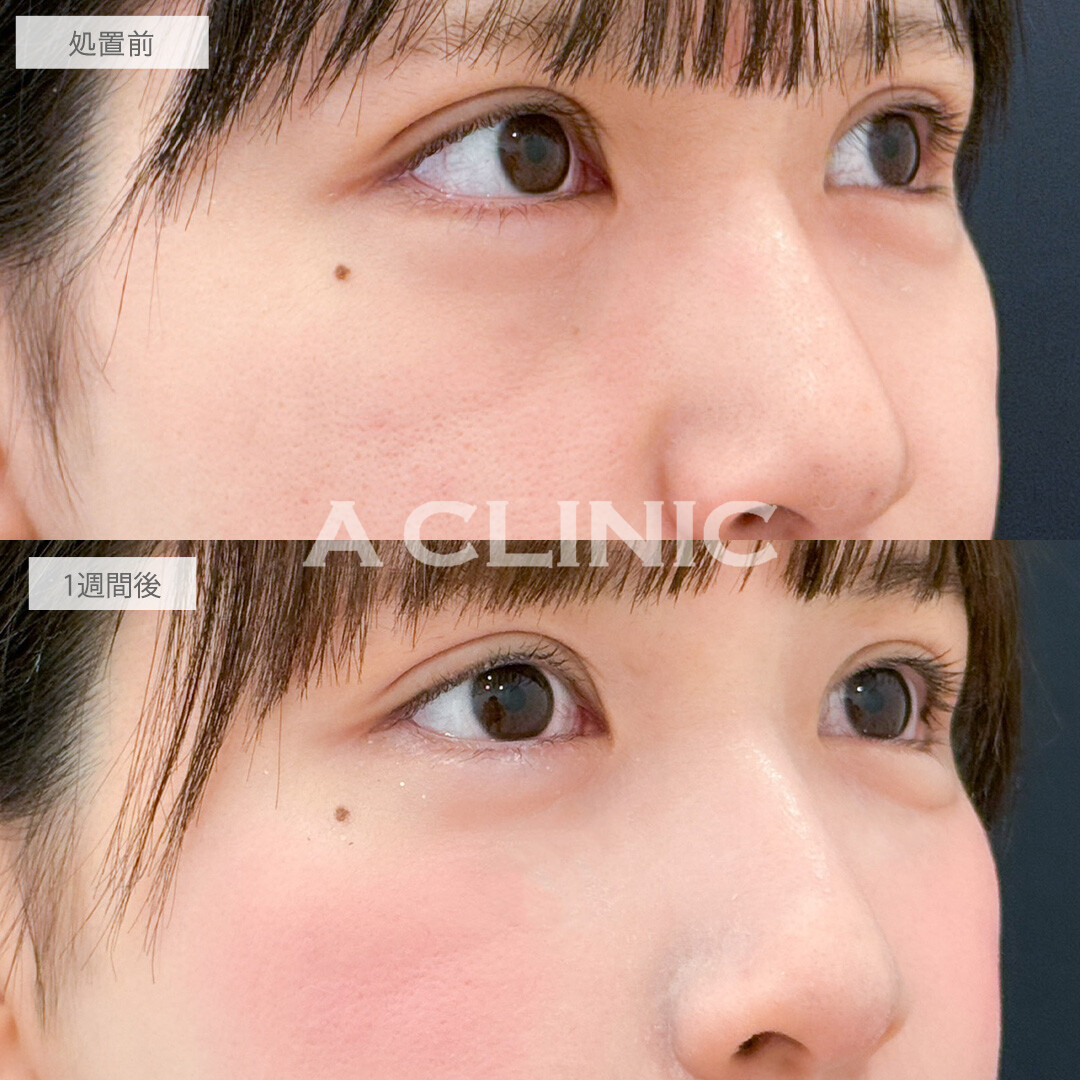 A式コンシーラー注射でふっくらハリ感を出して明るい印象の瞳に！こちら処置前と1週間後の症例です(20代女性)