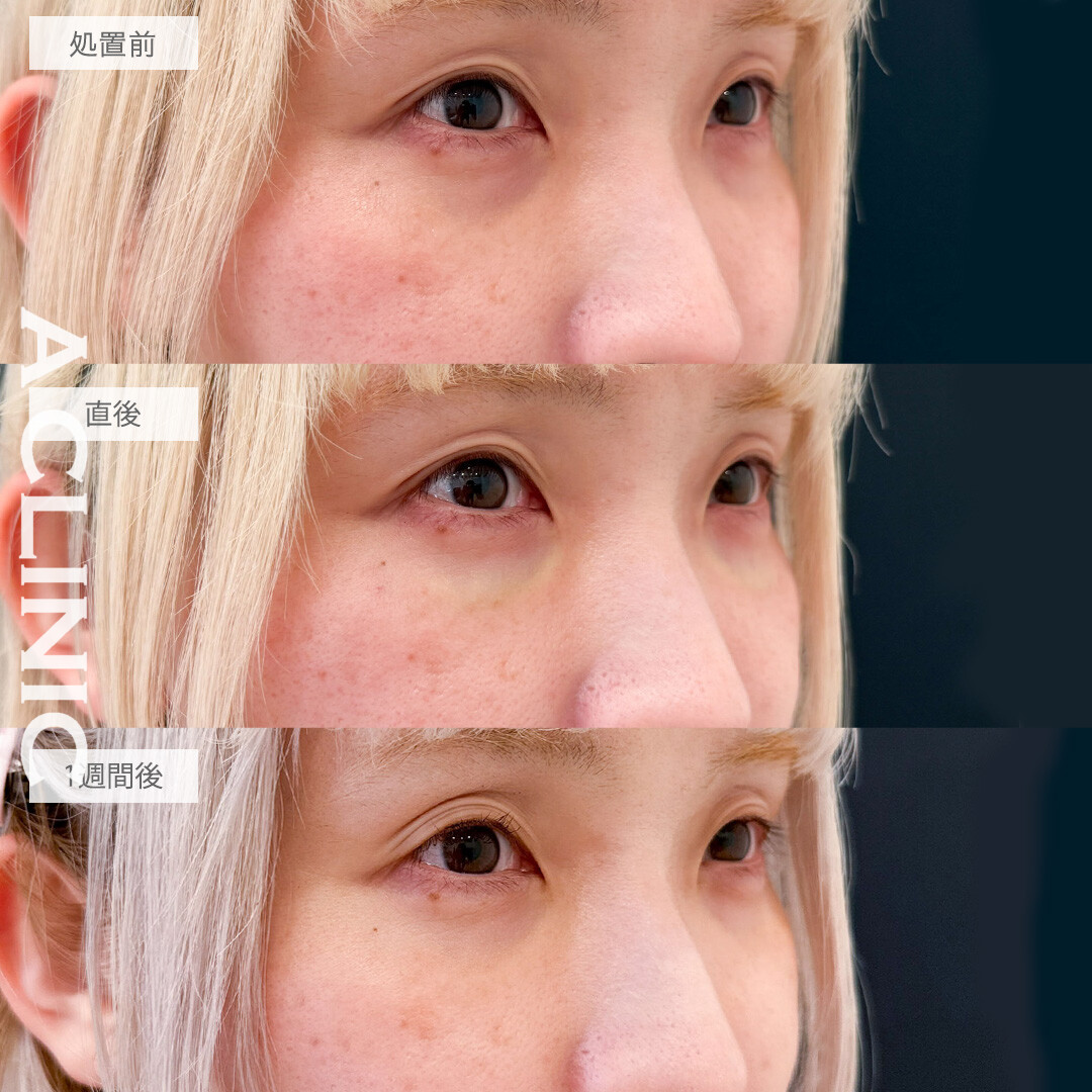 A式コンシーラー注射で色くまも凹みも一気に改善！こちら処置前から1週間後の症例です(30代女性)