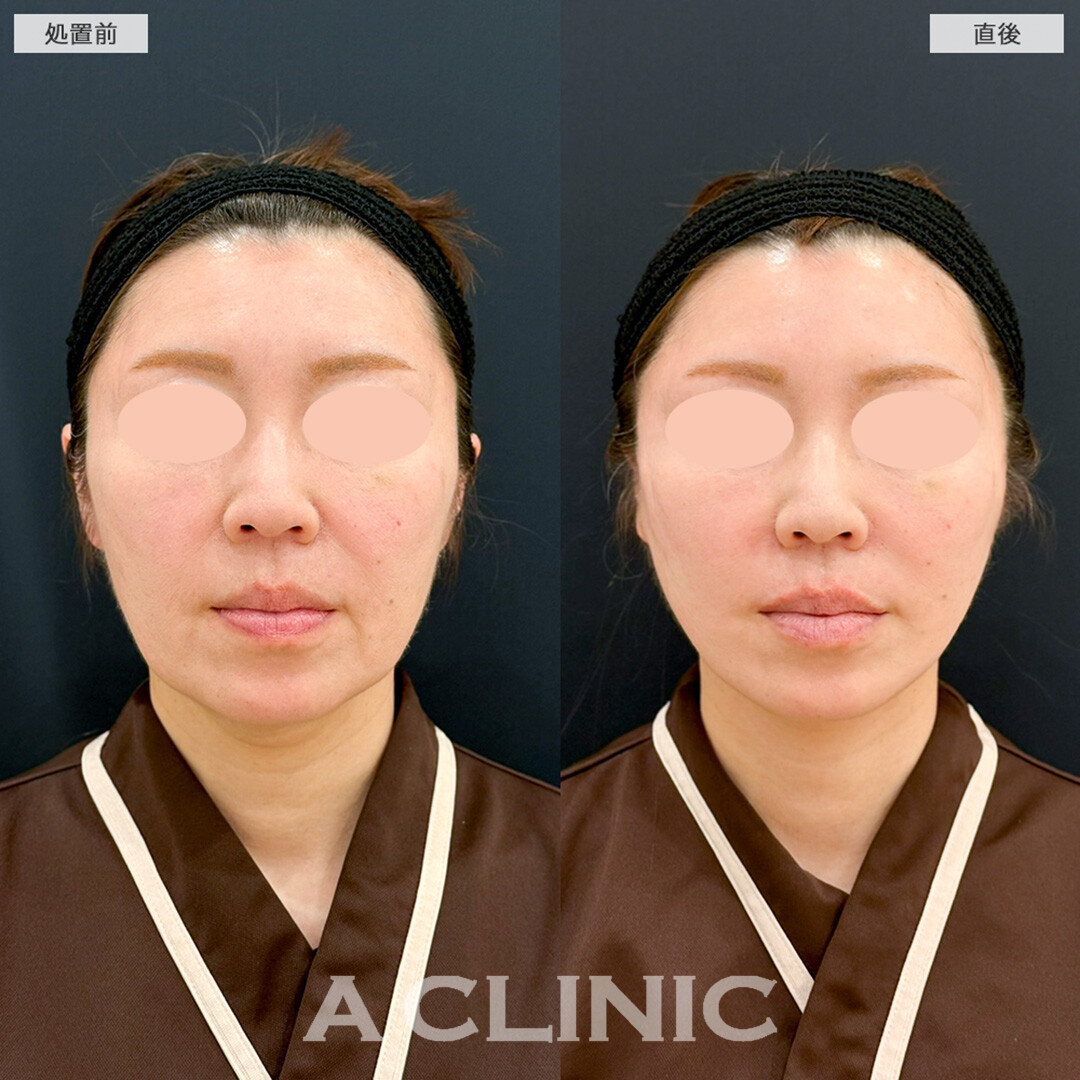Aスレッドならダウンタイム最小限で即日若返りが叶います！こちら処置前と直後の症例です(50代女性)