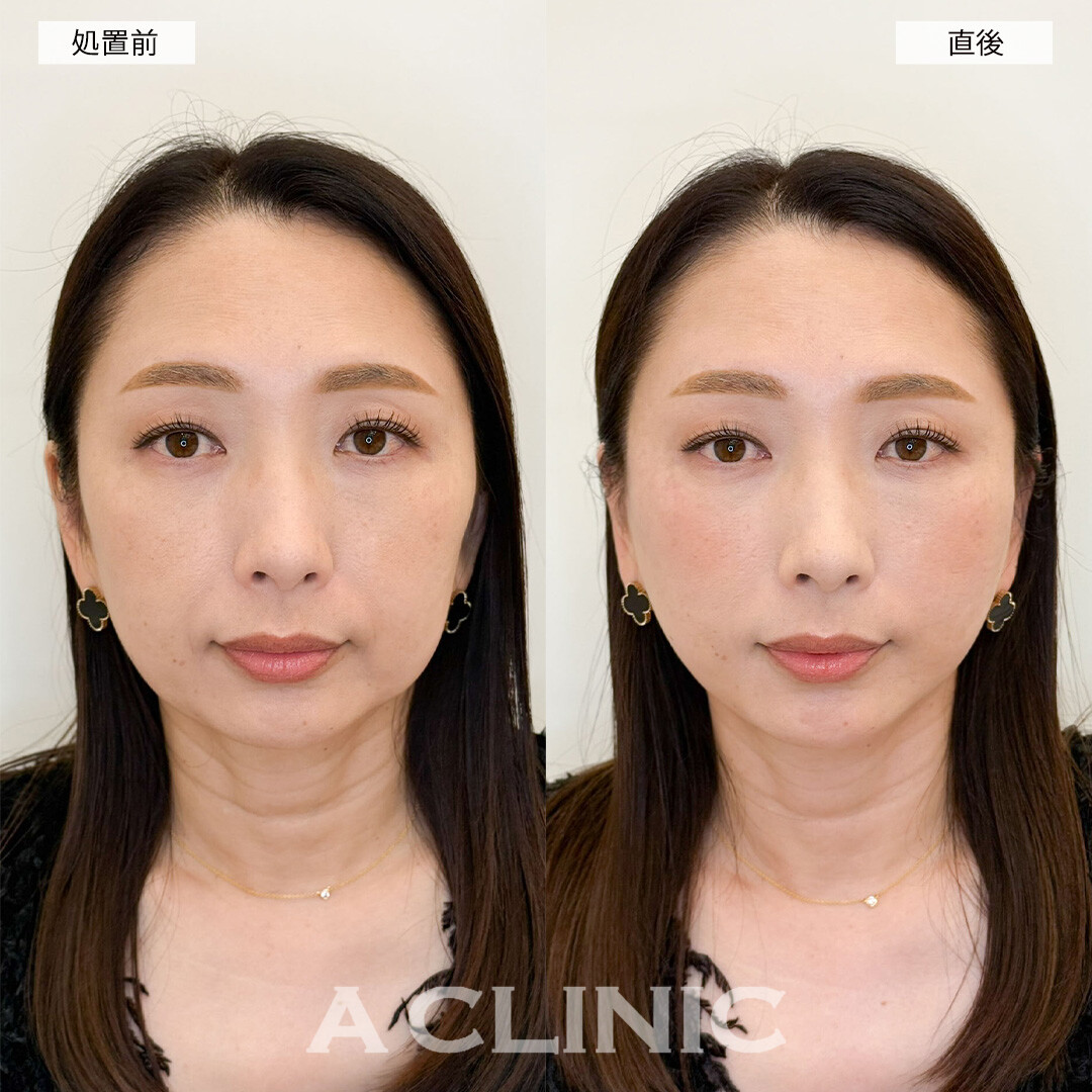 Aスレッドで長年のお悩みだった左右差改善！こちら処置前と直後の症例です(40代女性)