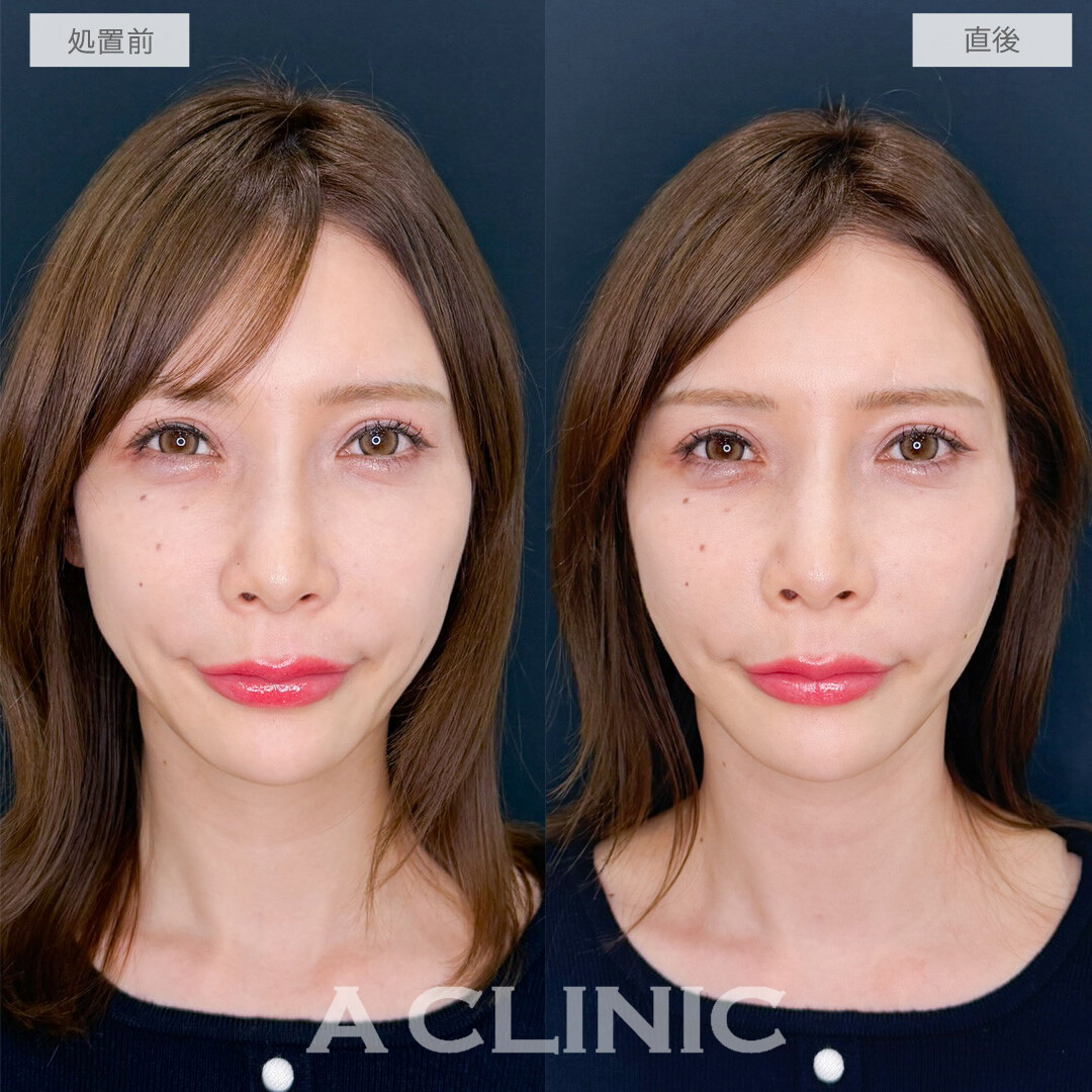 Aスレッドでたるみを引き上げ15分で若返り！こちら処置前と直後の症例です(40代女性)