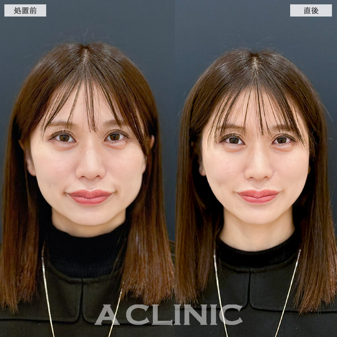 Aスレッドでもたつきを引き上げて四角い輪郭から卵形輪郭へ近づける！こちら処置前と直後の症例です(30代女性)