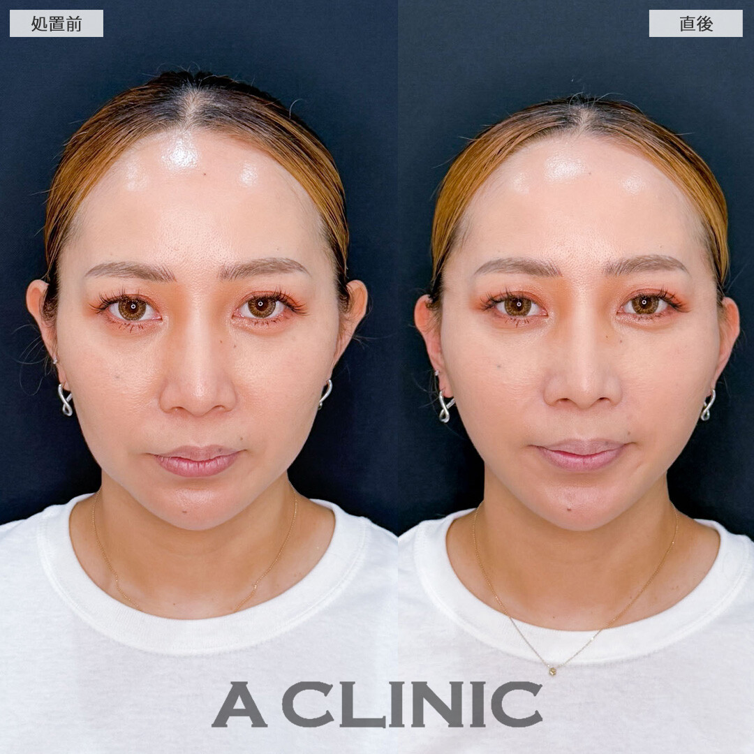 AスレッドでVラインとハリ感を整え即座に若々しい印象へ！こちら処置前と直後の症例です(40代女性)