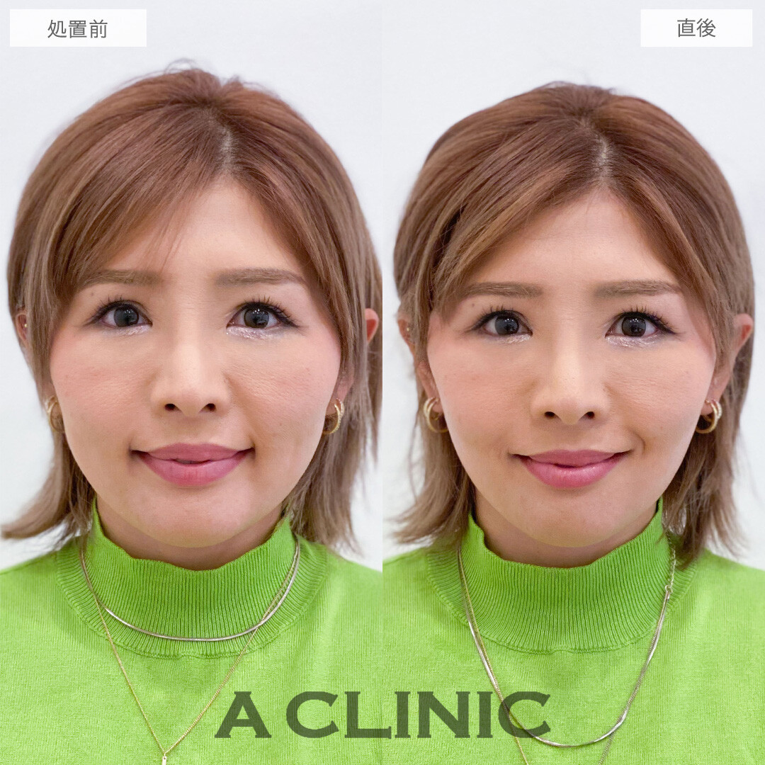Aスレッドでもたつきを自然に持ち上げ美輪郭をデザイン！こちら処置前と直後の症例です(30代女性)