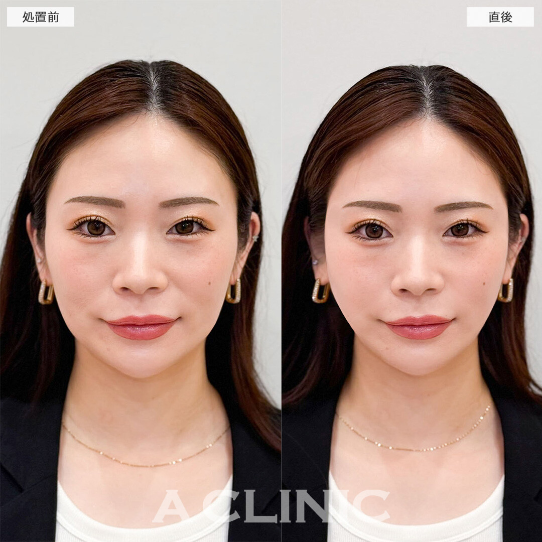 Aスレッドで口元のもたつきを改善し更に自信を持てる小顔へ！こちら処置前と直後の症例です(30代女性)