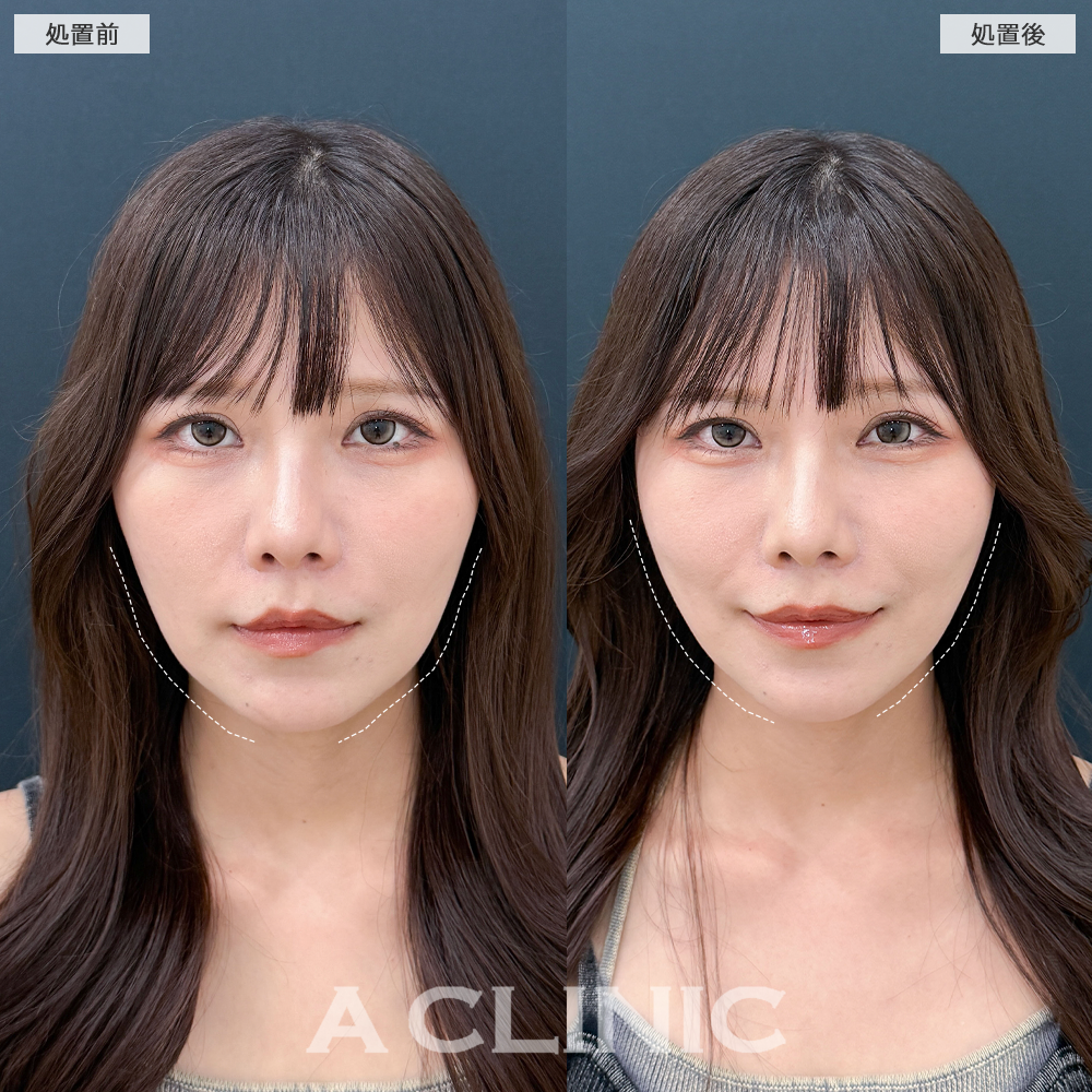 Aスレッドで輪郭の凸凹が改善し洗練された輪郭になりました！こちら処置前と直後の症例です(30代女性)