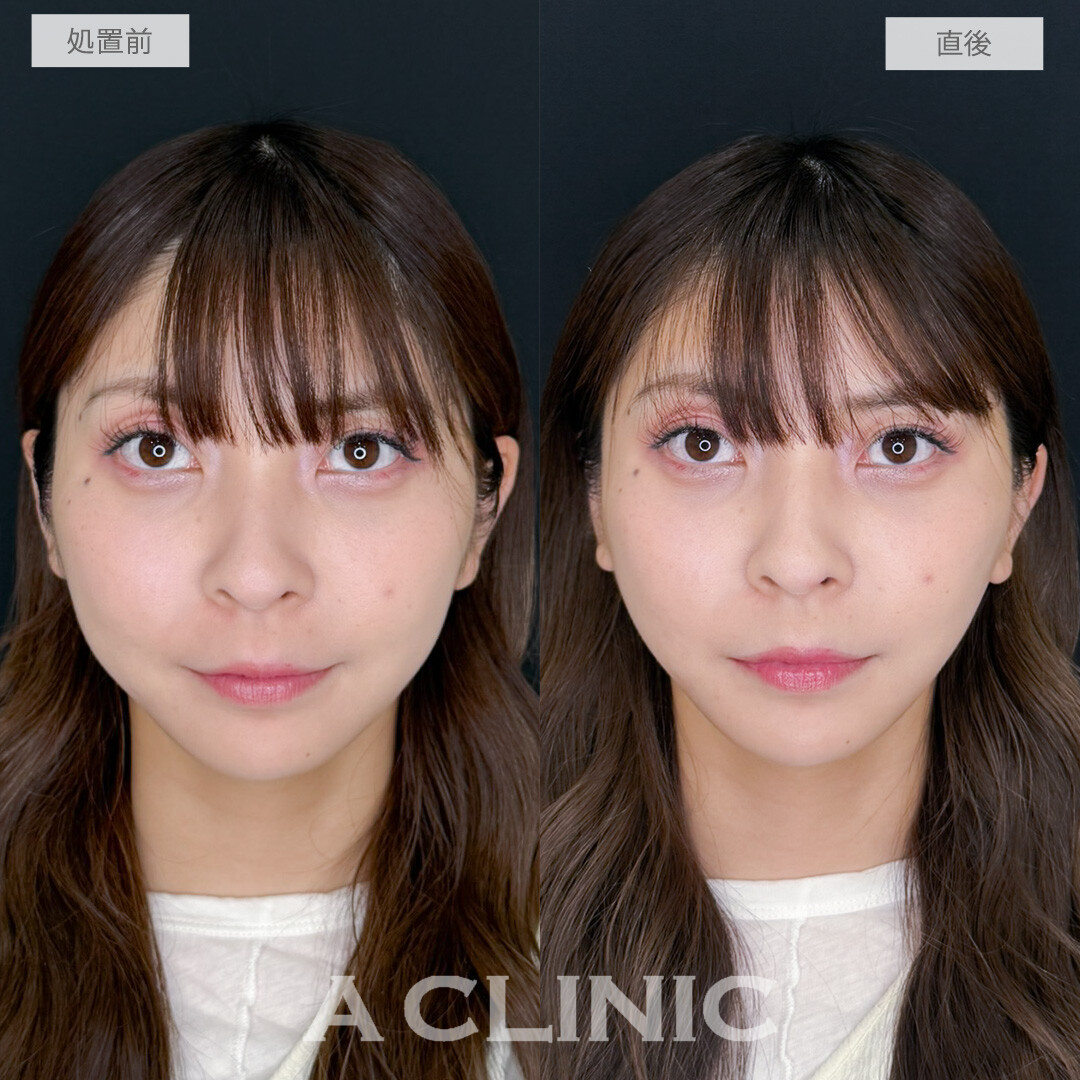 AスレッドのVフェイス形成でプチアップデート！処置前と直後の症例です(30代女性)