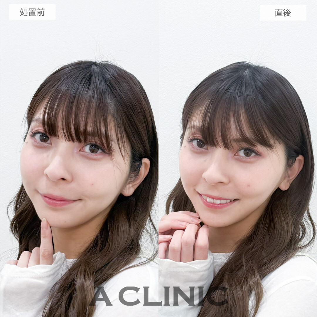 AスレッドのVフェイス形成でプチアップデート！処置前と直後の症例です(30代女性)