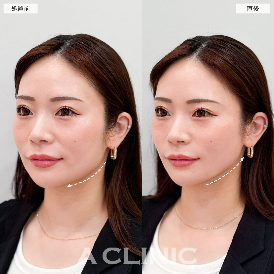 Aスレッドで口元のもたつきを改善し更に自信を持てる小顔へ！こちら処置前と直後の症例です(30代女性)