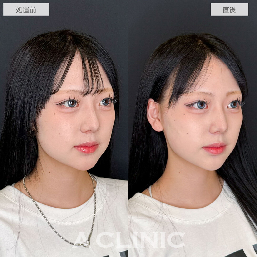 Aスレッドのみで下重心の輪郭が自然に改善！こちら処置前と直後の症例です(20代女性)