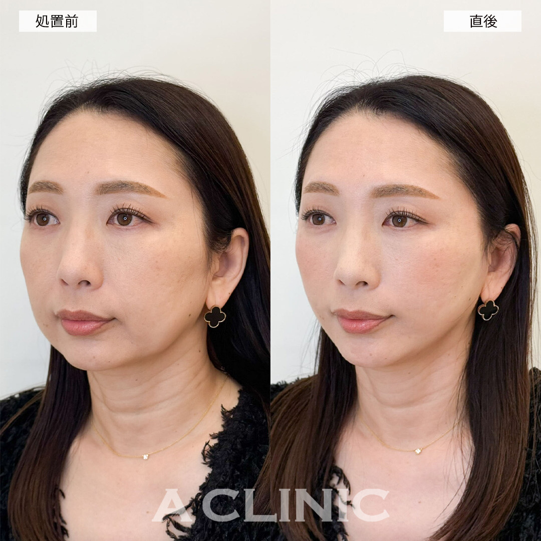 Aスレッドで長年のお悩みだった左右差改善！こちら処置前と直後の症例です(40代女性)