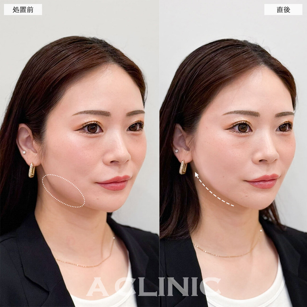 Aスレッドで口元のもたつきを改善し更に自信を持てる小顔へ！こちら処置前と直後の症例です(30代女性)