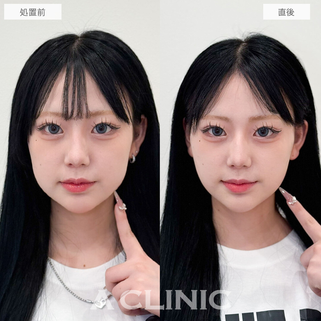 Aスレッドのみで下重心の輪郭が自然に改善！こちら処置前と直後の症例です(20代女性)