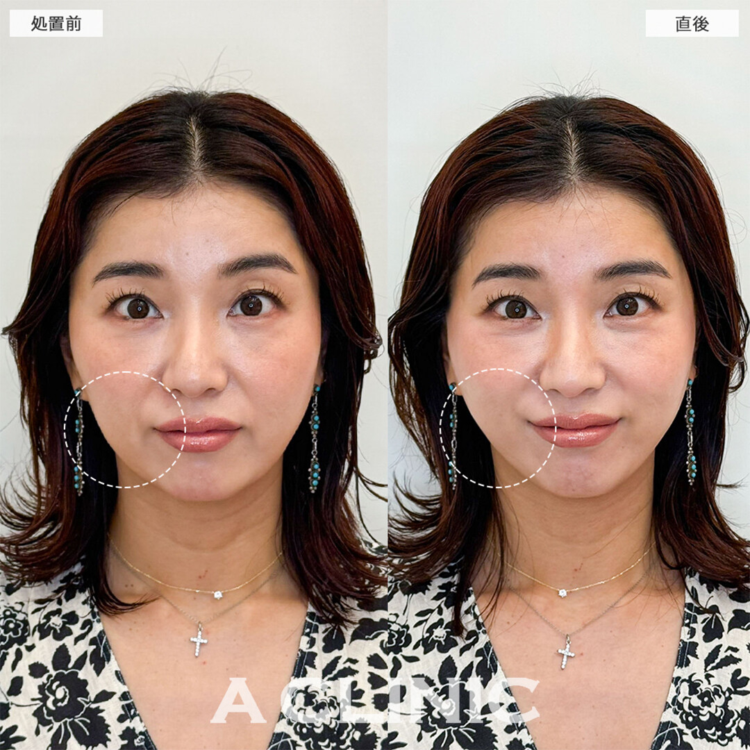 Aスレッドは即効性のある若返り施術です！こちら処置前と直後の症例です(40代女性)