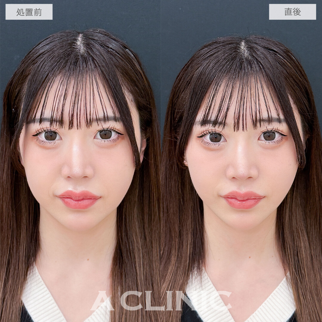 Aスレッドでお疲れ顔を最速で卒業できました！こちら処置前と直後の症例です(20代女性)