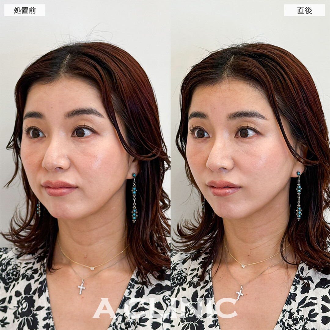 Aスレッドは即効性のある若返り施術です！こちら処置前と直後の症例です(40代女性)