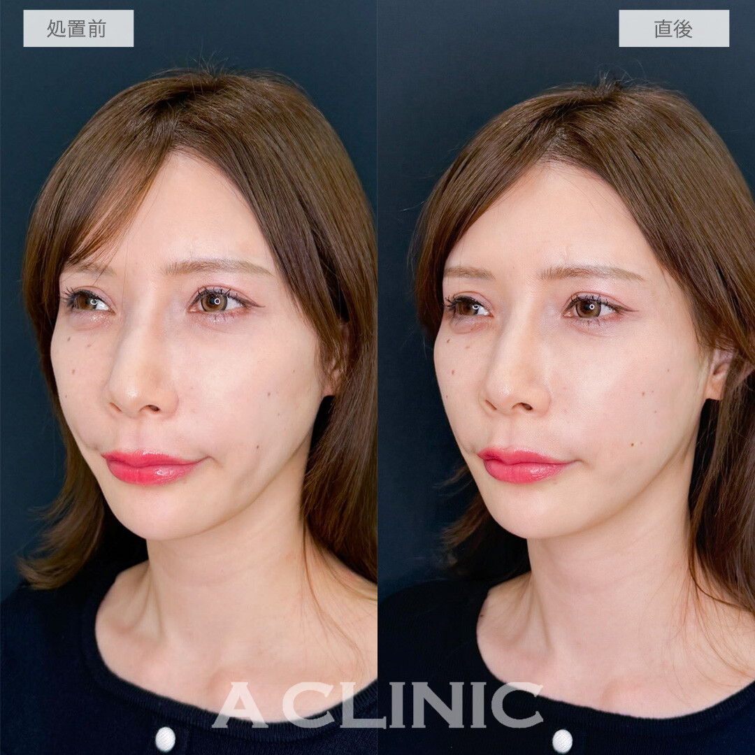 Aスレッドでたるみを引き上げ15分で若返り！こちら処置前と直後の症例です(40代女性)