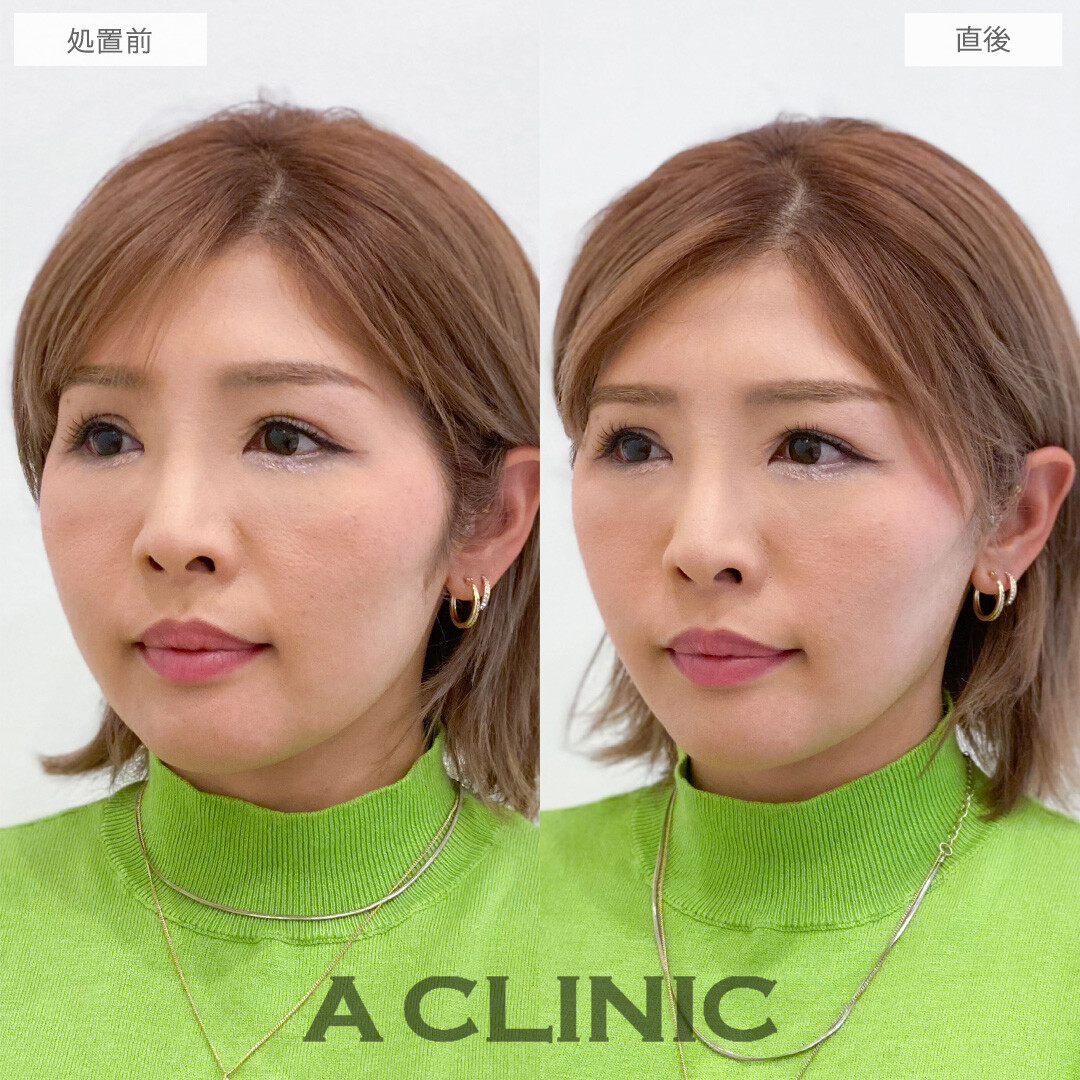 Aスレッドでもたつきを自然に持ち上げ美輪郭をデザイン！こちら処置前と直後の症例です(30代女性)