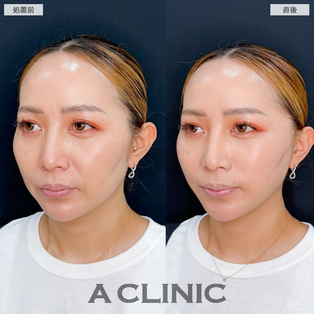 AスレッドでVラインとハリ感を整え即座に若々しい印象へ！こちら処置前と直後の症例です(40代女性)