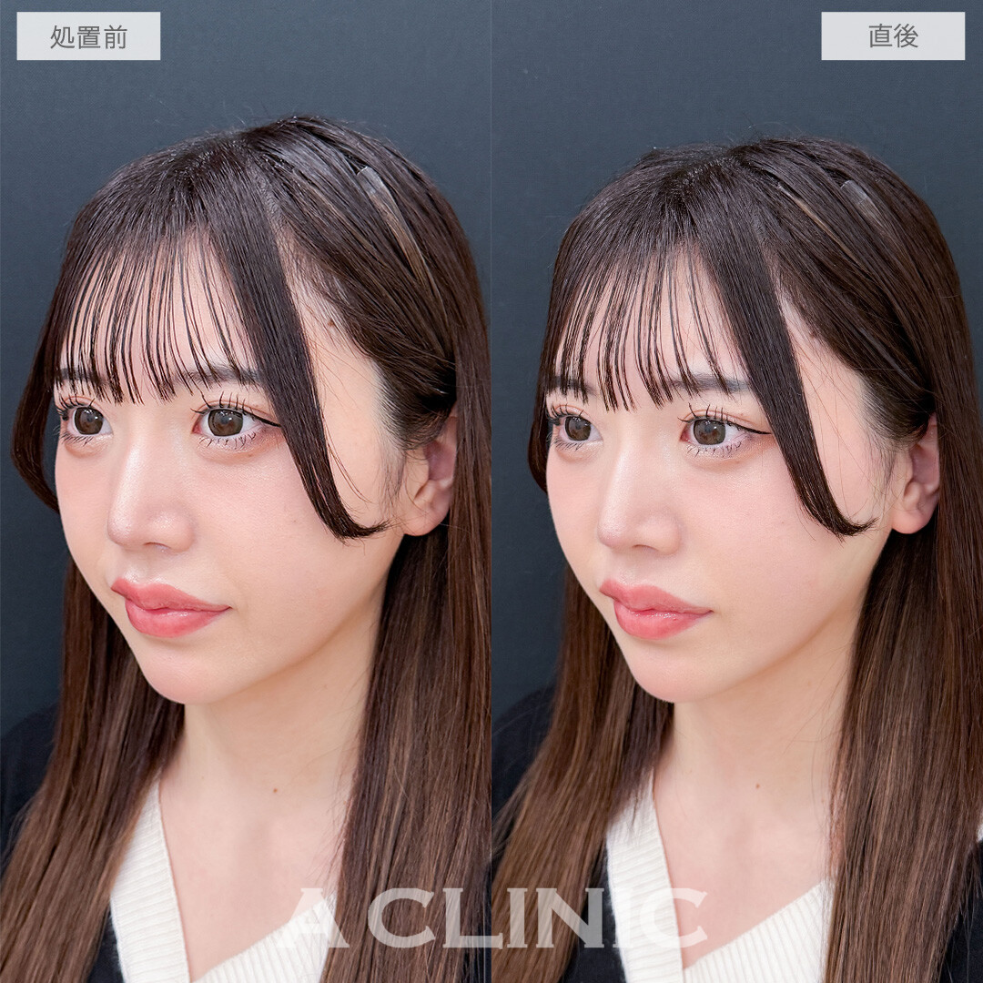 Aスレッドでお疲れ顔を最速で卒業できました！こちら処置前と直後の症例です(20代女性)