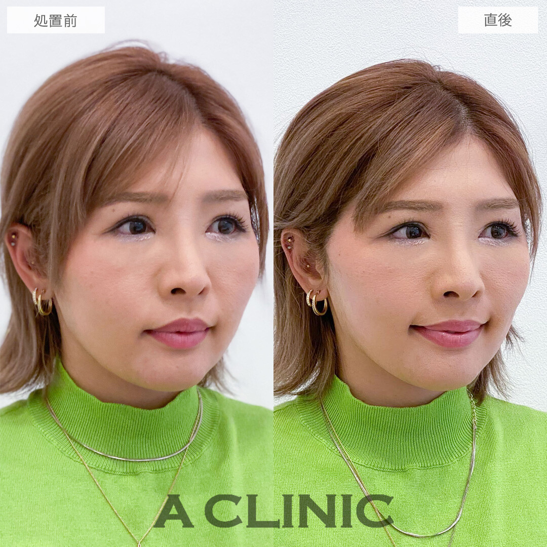 Aスレッドでもたつきを自然に持ち上げ美輪郭をデザイン！こちら処置前と直後の症例です(30代女性)