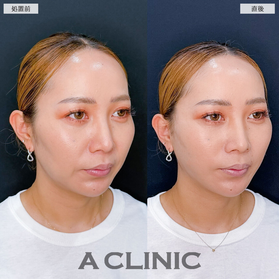 AスレッドでVラインとハリ感を整え即座に若々しい印象へ！こちら処置前と直後の症例です(40代女性)