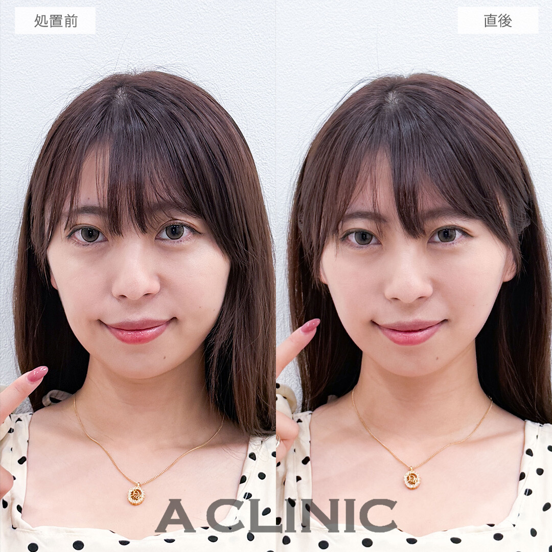 Aスレッドで自然だけどがっつり輪郭を整えました！こちら処置前と直後の症例です(30代女性)