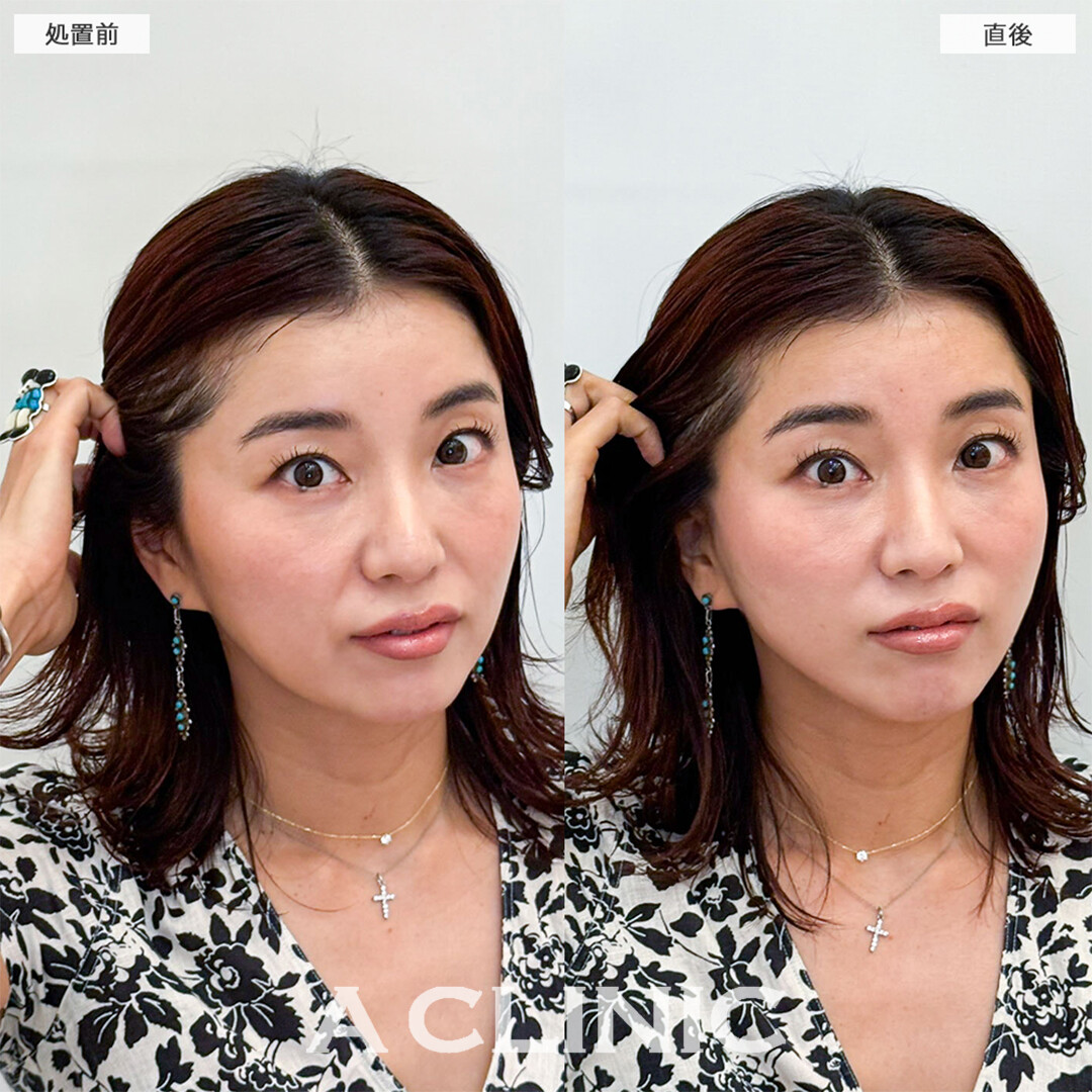 Aスレッドは即効性のある若返り施術です！こちら処置前と直後の症例です(40代女性)