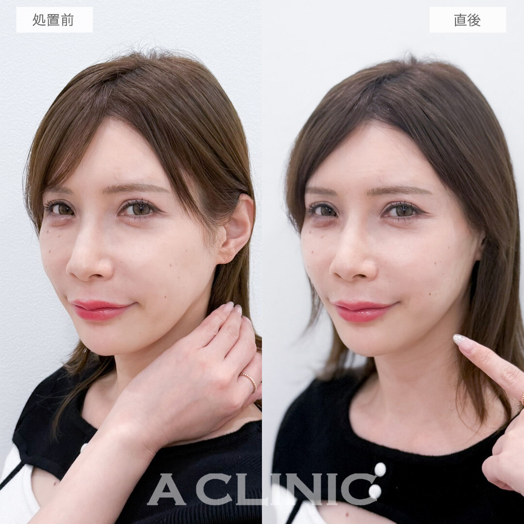 Aスレッドでたるみを引き上げ15分で若返り！こちら処置前と直後の症例です(40代女性)