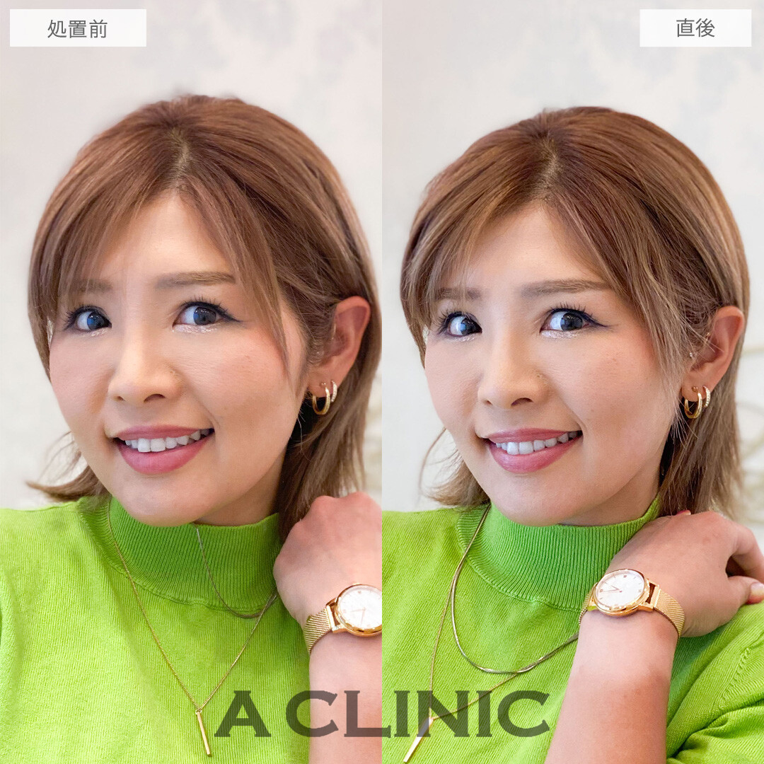 Aスレッドでもたつきを自然に持ち上げ美輪郭をデザイン！こちら処置前と直後の症例です(30代女性)