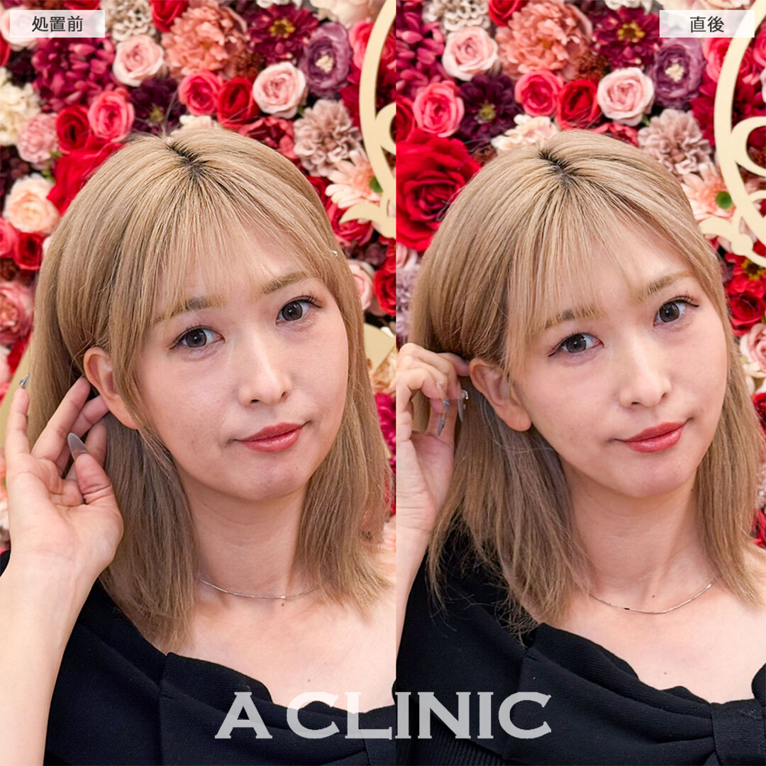 Aスレッドで左右差やもたつきが解消し笑顔に自信が持てました！こちら処置前と直後の症例です(40代女性)