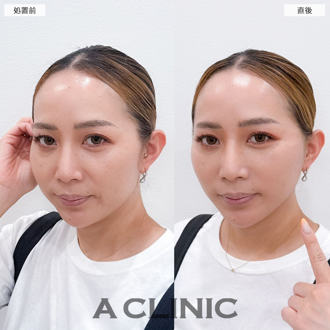 AスレッドでVラインとハリ感を整え即座に若々しい印象へ！こちら処置前と直後の症例です(40代女性)