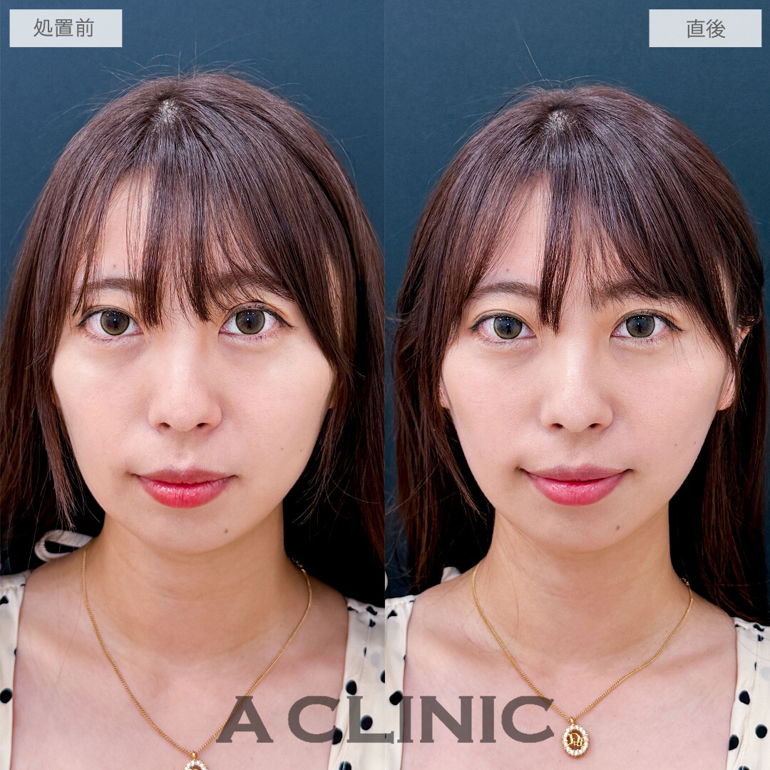 Aスレッドで自然だけどがっつり輪郭を整えました！こちら処置前と直後の症例です(30代女性)
