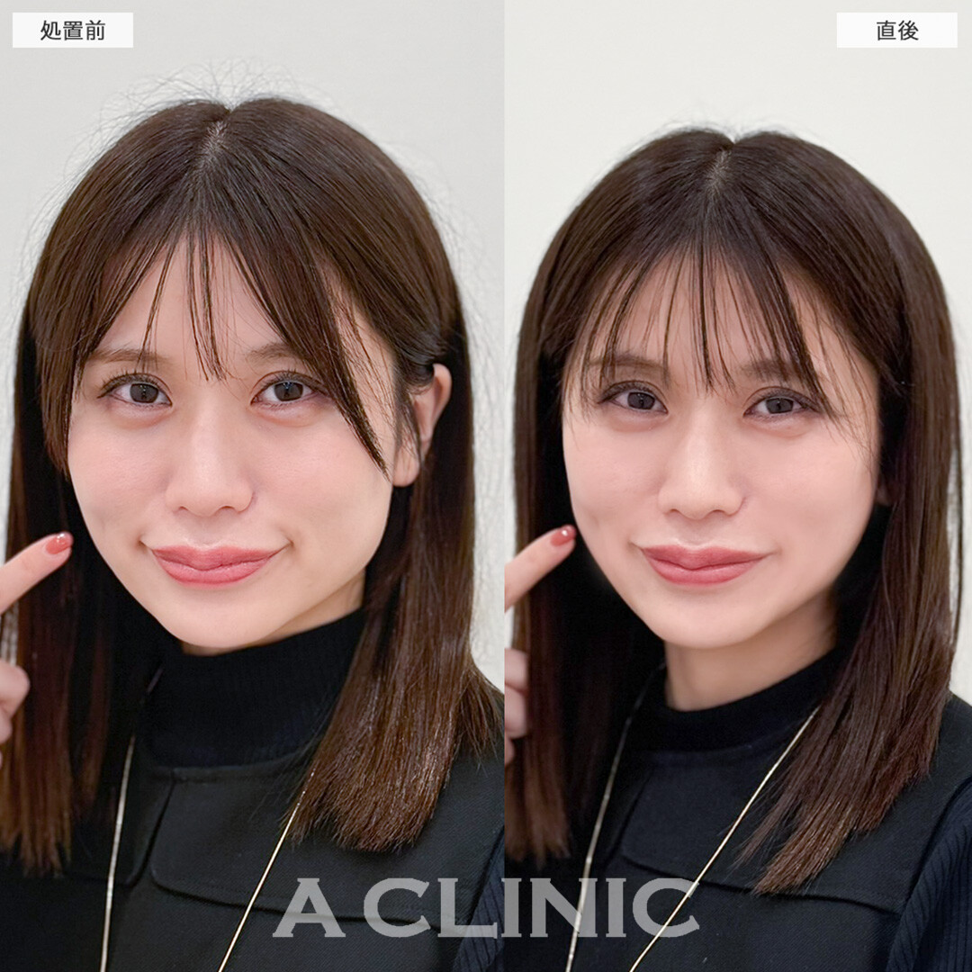 Aスレッドでもたつきを引き上げて四角い輪郭から卵形輪郭へ近づける！こちら処置前と直後の症例です(30代女性)