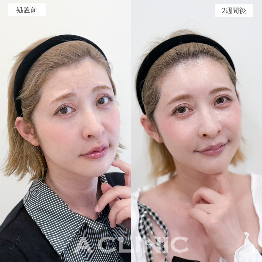 ヒアルロン酸カスタマイズメニューでしわが目立ちにくくなりハリ感アップ！処置前と2週間後の症例です(40代女性)