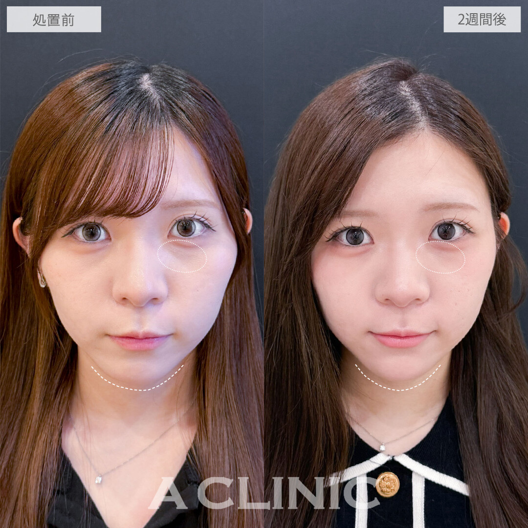 ヒアルロン酸カスタマイズメニューで目の下の影とあごの形を整え一気に垢抜け！こちら処置前と2週間後の症例です(20代女性)